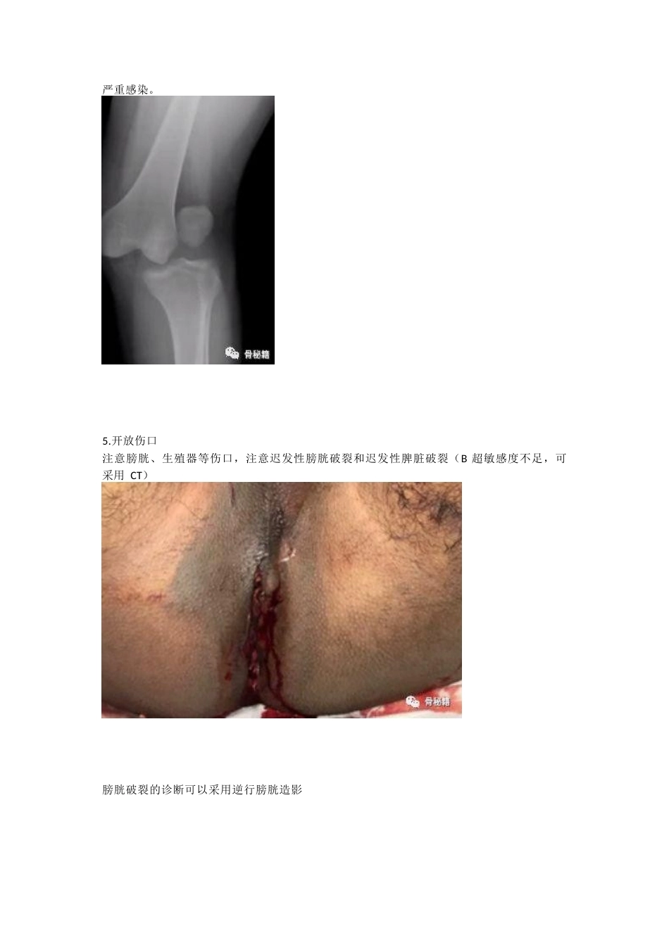 骨盆骨折的急 救治疗_第4页