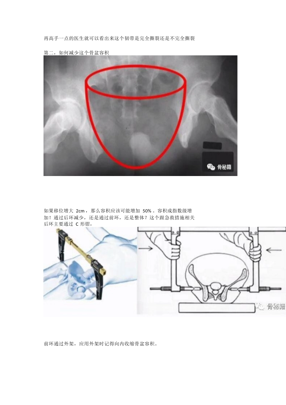 骨盆骨折的急 救治疗_第7页