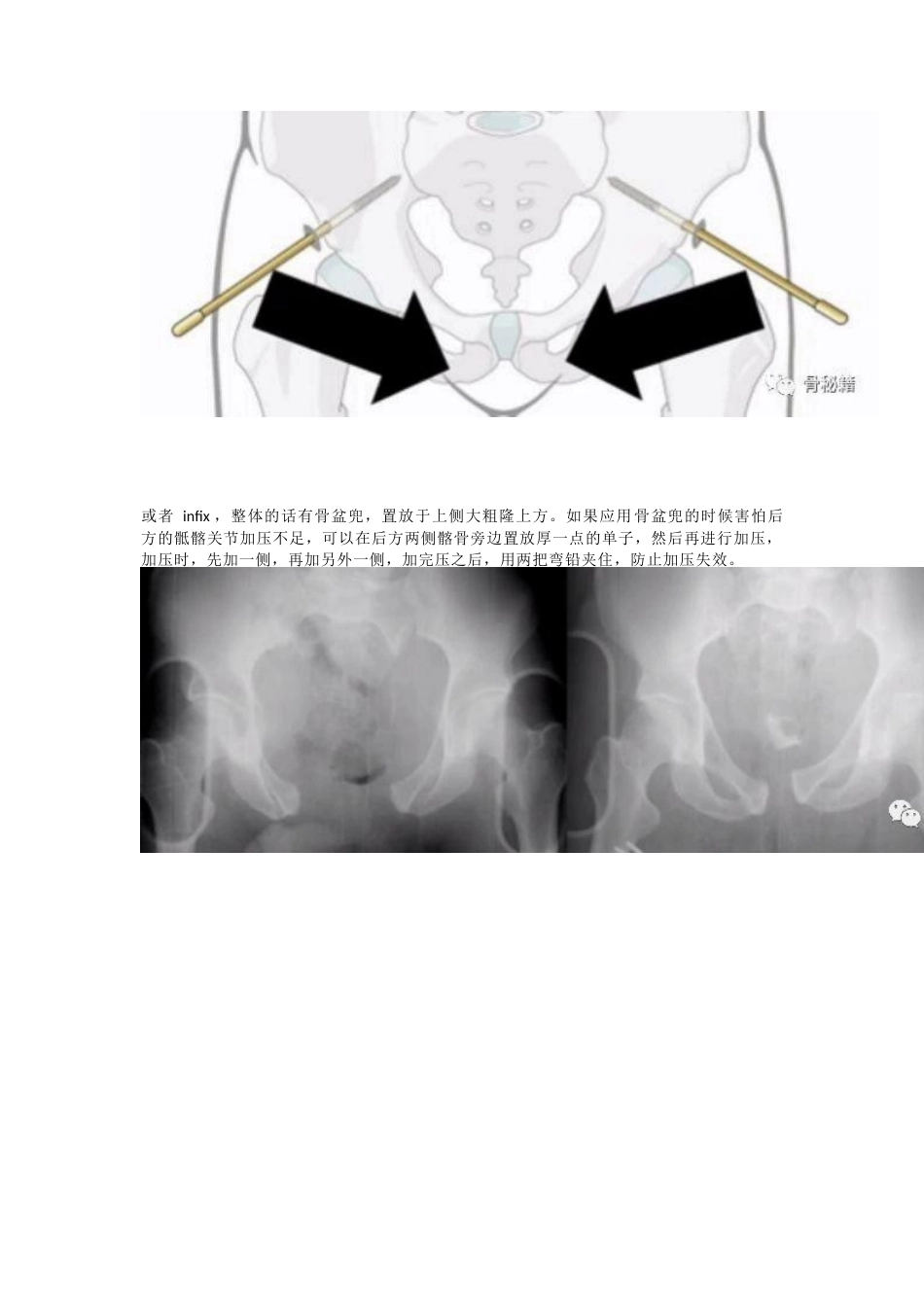 骨盆骨折的急 救治疗_第8页