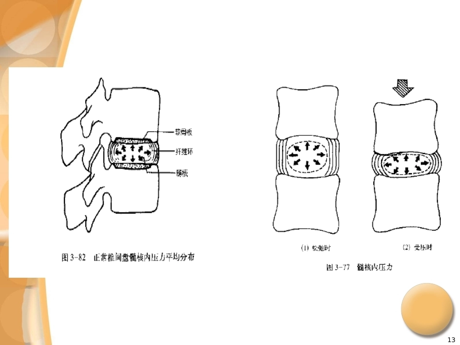 腰椎间盘突出症诊治PPT_第13页