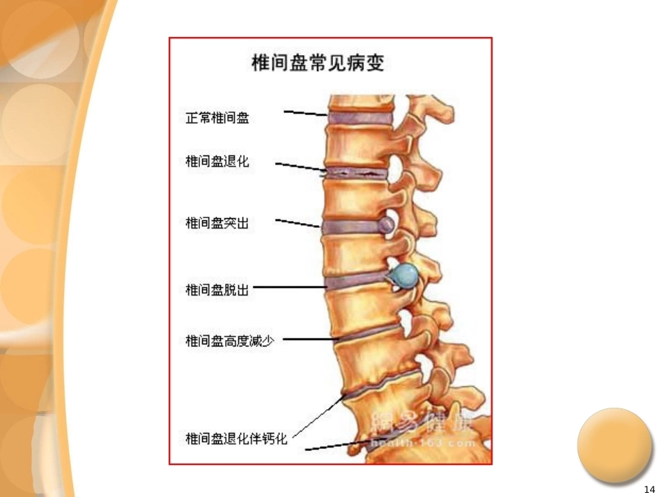 腰椎间盘突出症诊治PPT_第14页