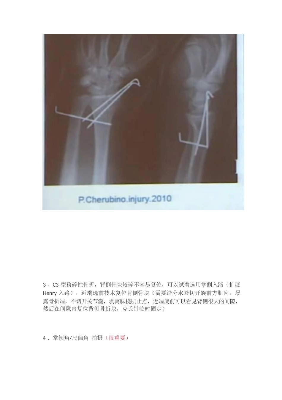 桡骨远端骨折钢板固 定的手术技巧_第12页