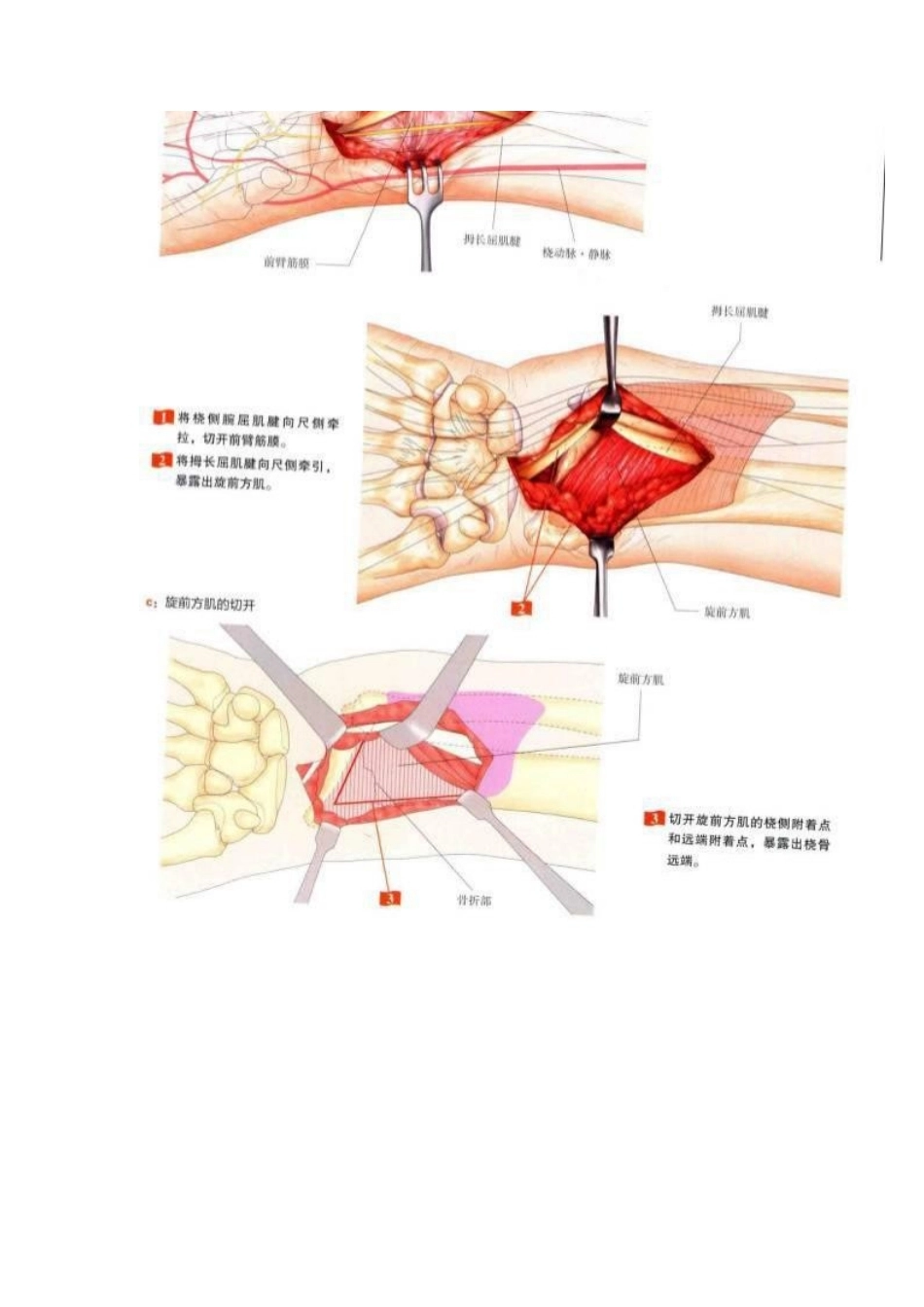 桡骨远端骨折钢板固 定的手术技巧_第5页