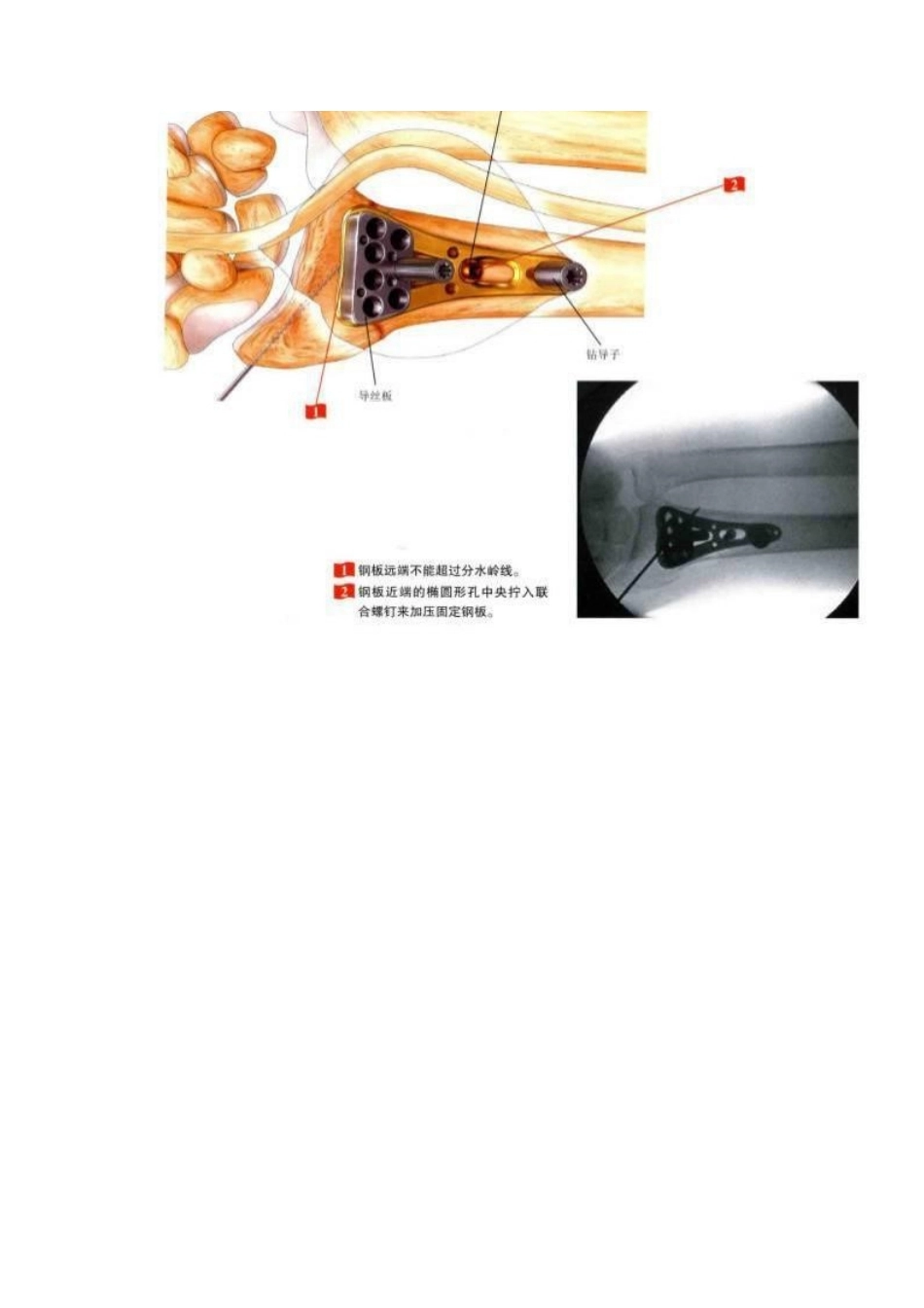 桡骨远端骨折钢板固 定的手术技巧_第7页