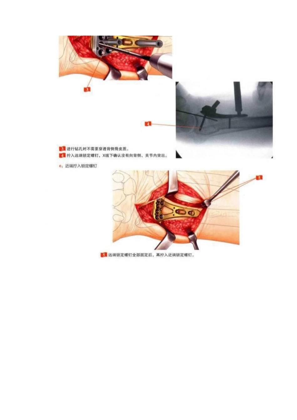 桡骨远端骨折钢板固 定的手术技巧_第8页