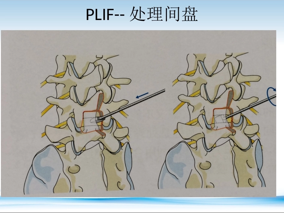 PLF-PLIF-TLIF-ALIF-DLIF-XLIF的技术对比_第12页