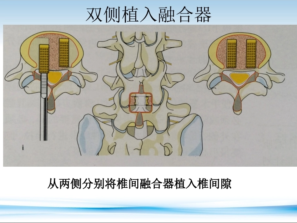 PLF-PLIF-TLIF-ALIF-DLIF-XLIF的技术对比_第13页