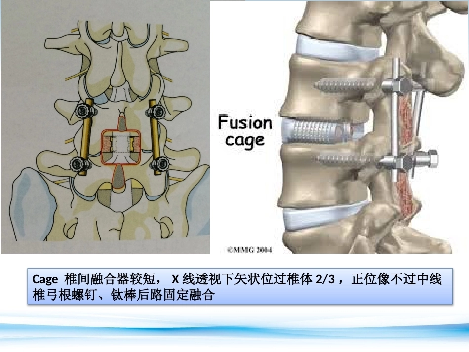 PLF-PLIF-TLIF-ALIF-DLIF-XLIF的技术对比_第14页