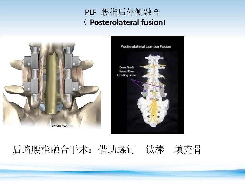 PLF-PLIF-TLIF-ALIF-DLIF-XLIF的技术对比_第7页