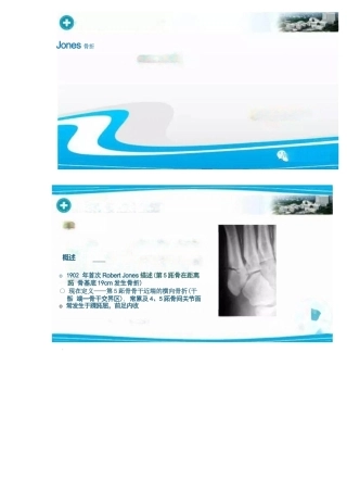 足部Jones骨折的分类与治疗