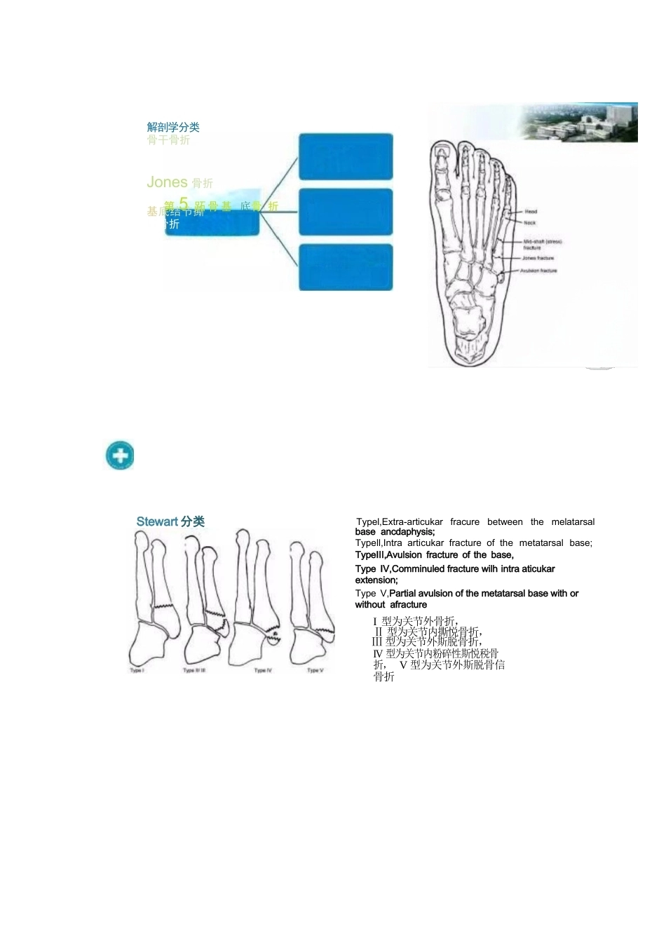 足部Jones骨折的分类与治疗_第2页