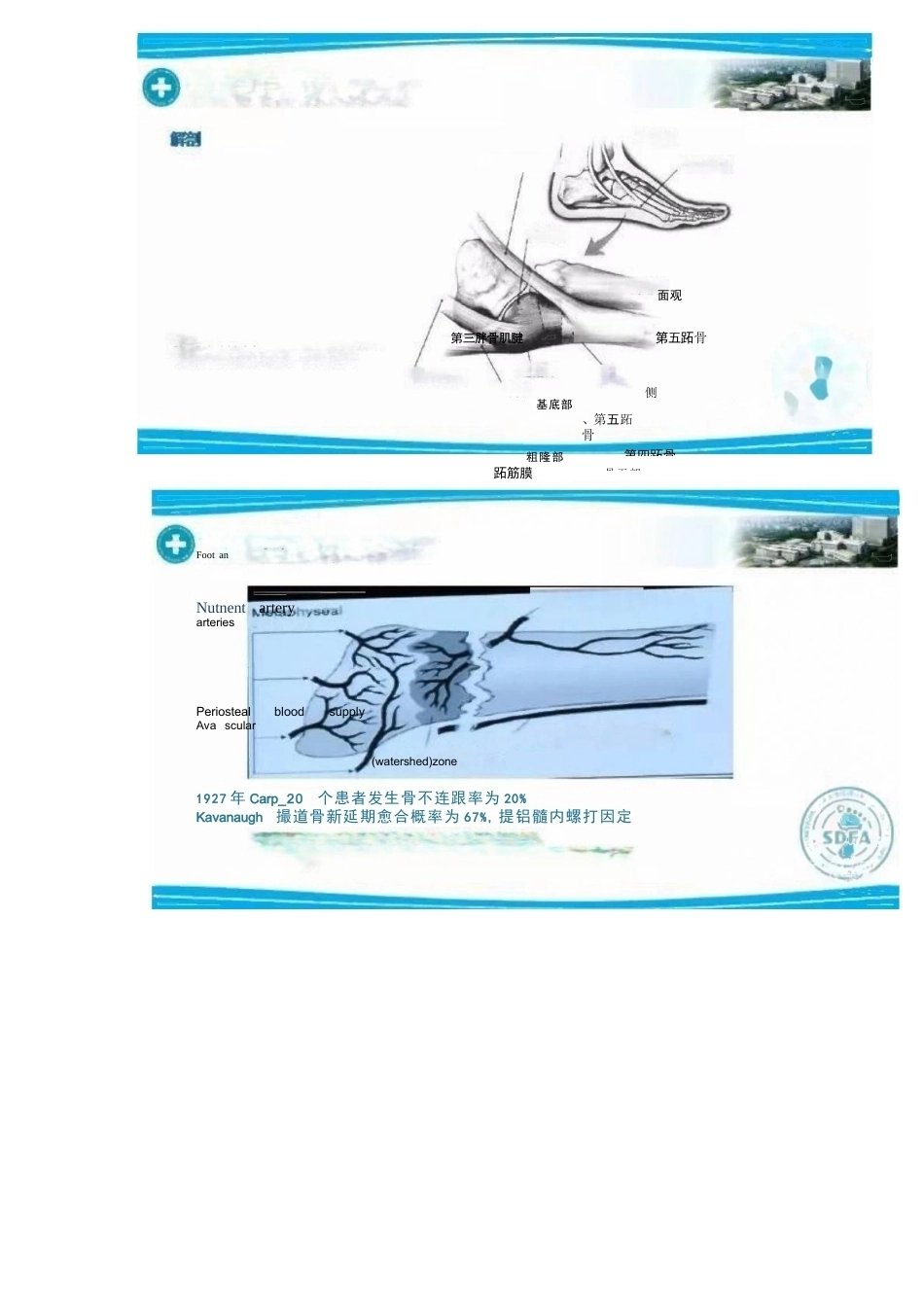足部Jones骨折的分类与治疗_第4页