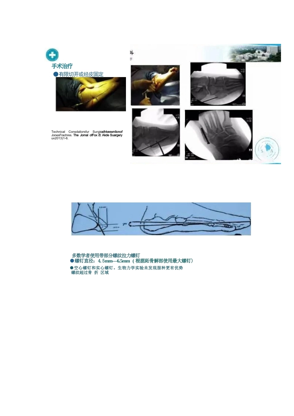 足部Jones骨折的分类与治疗_第6页