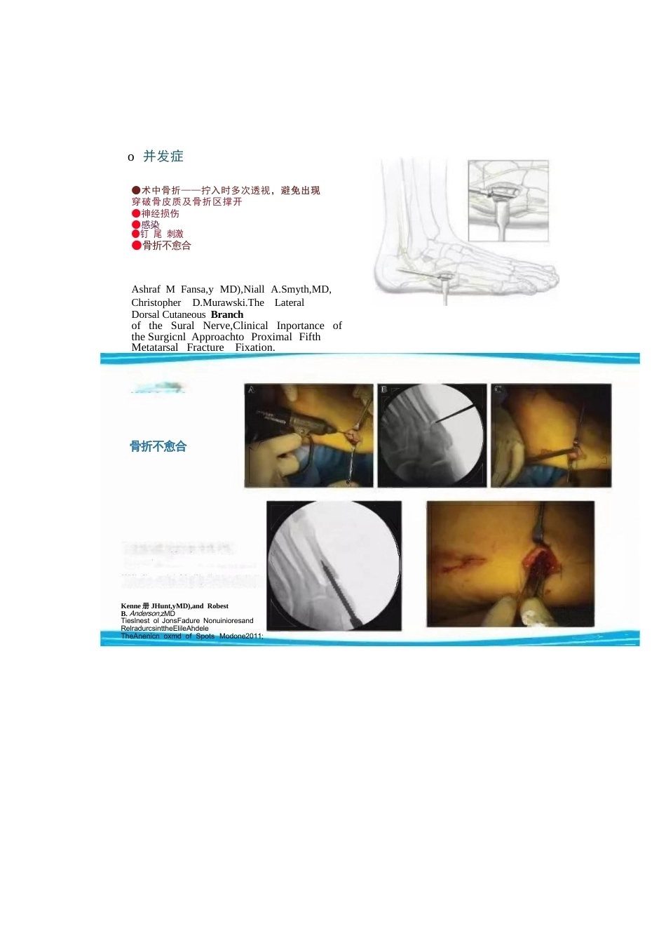 足部Jones骨折的分类与治疗_第7页
