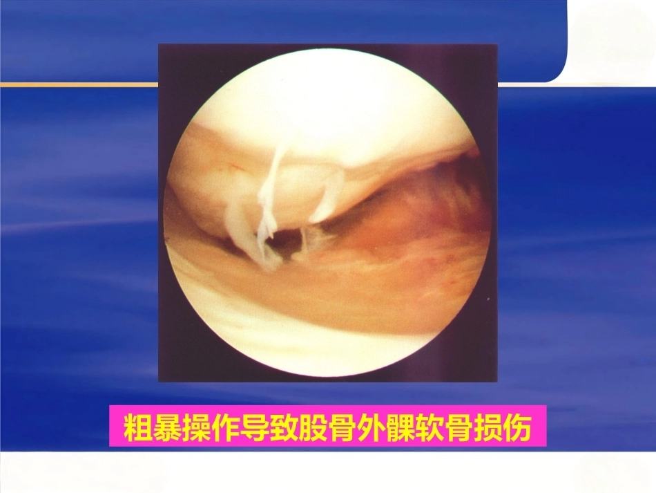 膝关节关节 镜手术并发症_第6页