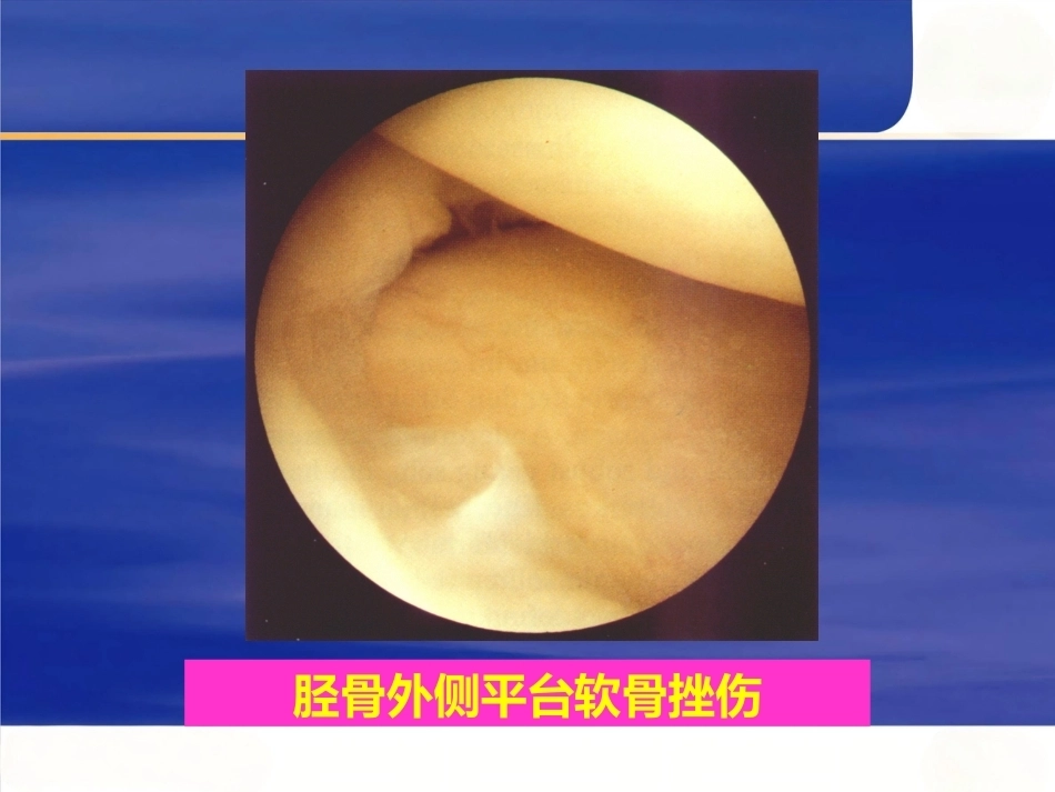 膝关节关节 镜手术并发症_第7页
