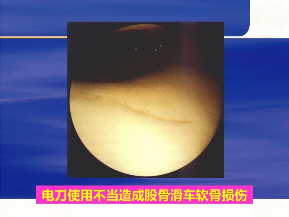 膝关节关节 镜手术并发症_第8页