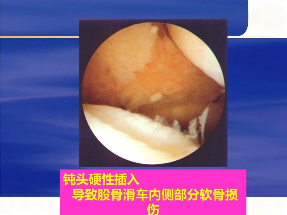 膝关节关节 镜手术并发症_第9页