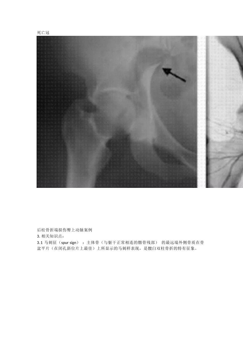 髋臼骨折分型_第15页