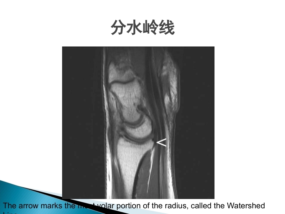 桡骨远端骨折课件_第10页