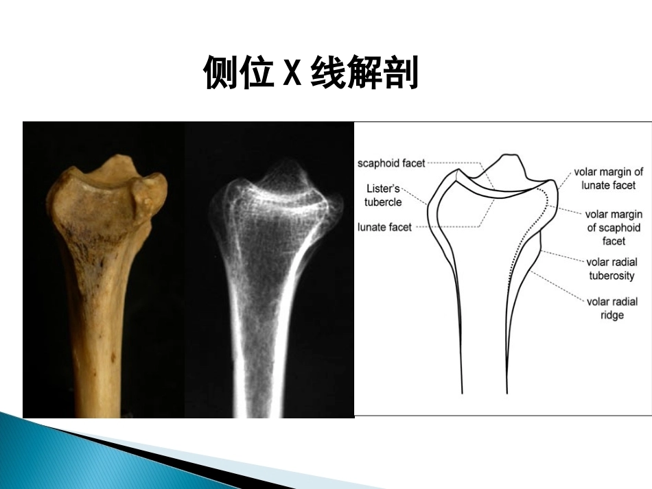 桡骨远端骨折课件_第11页