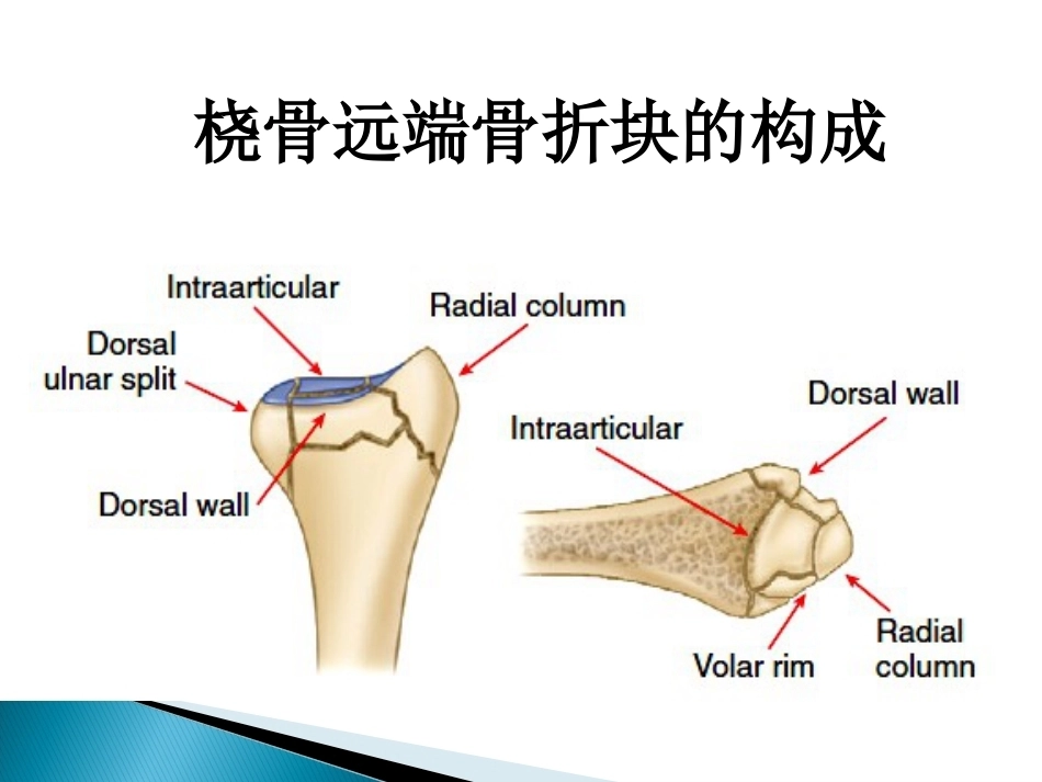桡骨远端骨折课件_第12页