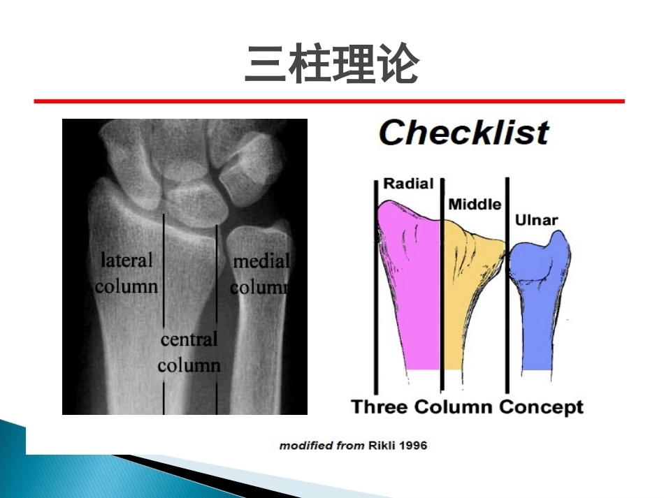 桡骨远端骨折课件_第15页