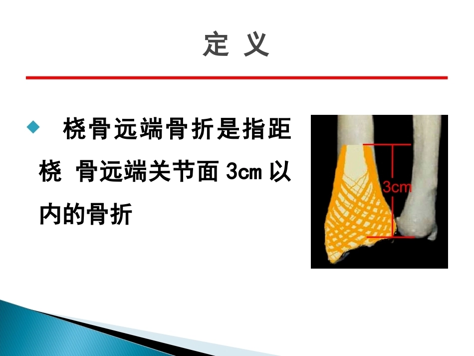 桡骨远端骨折课件_第3页