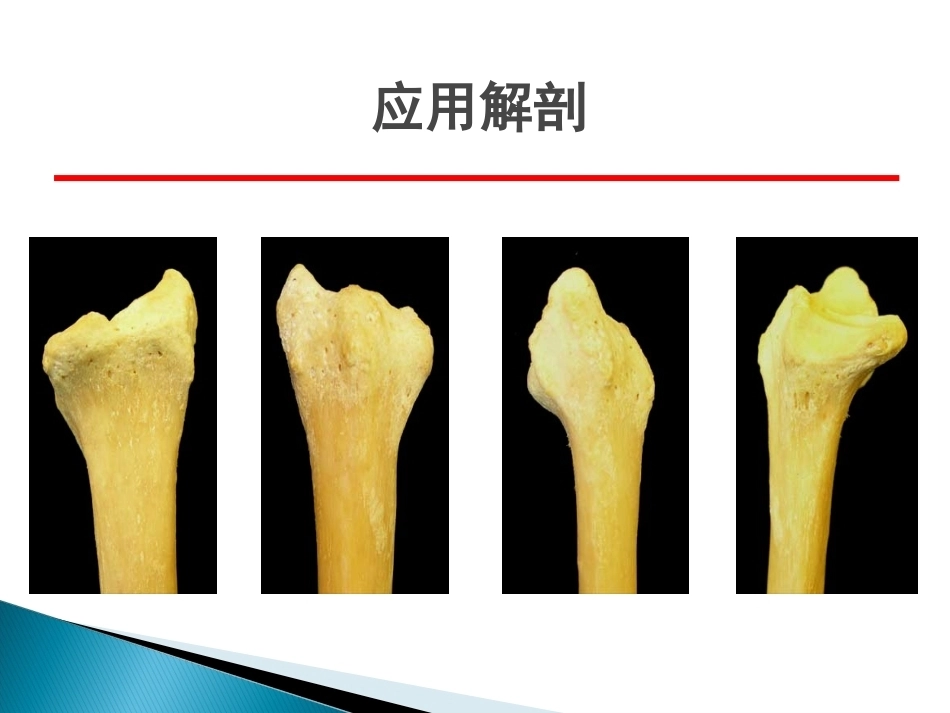 桡骨远端骨折课件_第5页