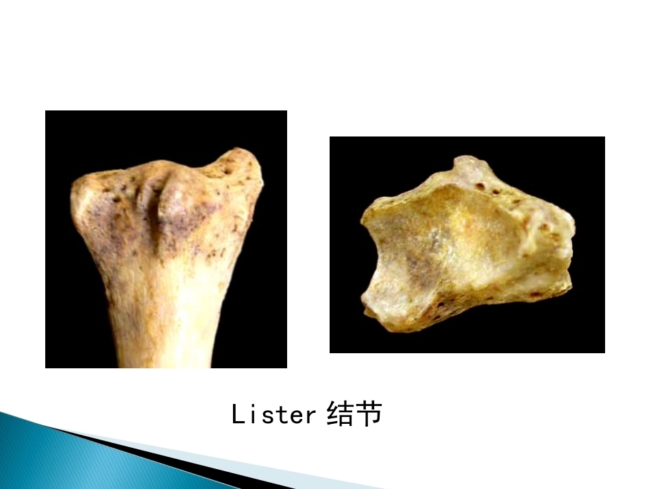 桡骨远端骨折课件_第6页