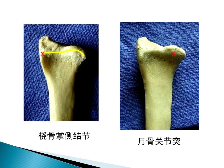 桡骨远端骨折课件_第7页