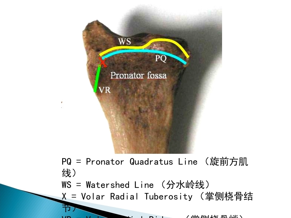 桡骨远端骨折课件_第8页