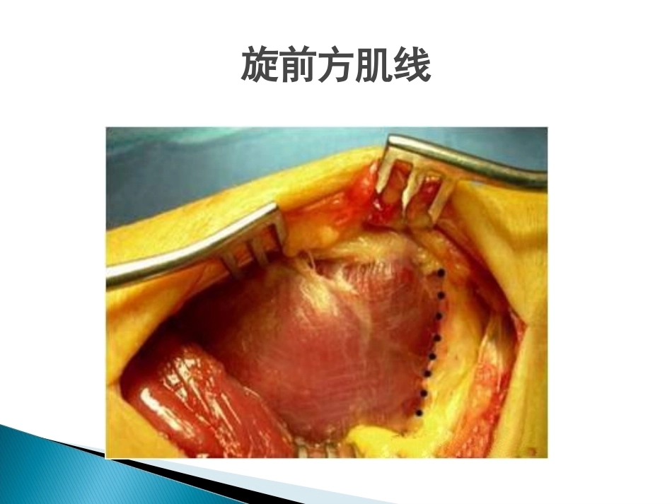 桡骨远端骨折课件_第9页