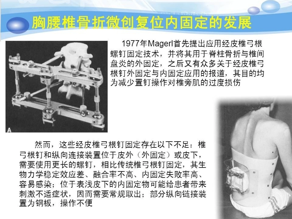 急性胸腰椎骨折的手 术 技巧_第10页