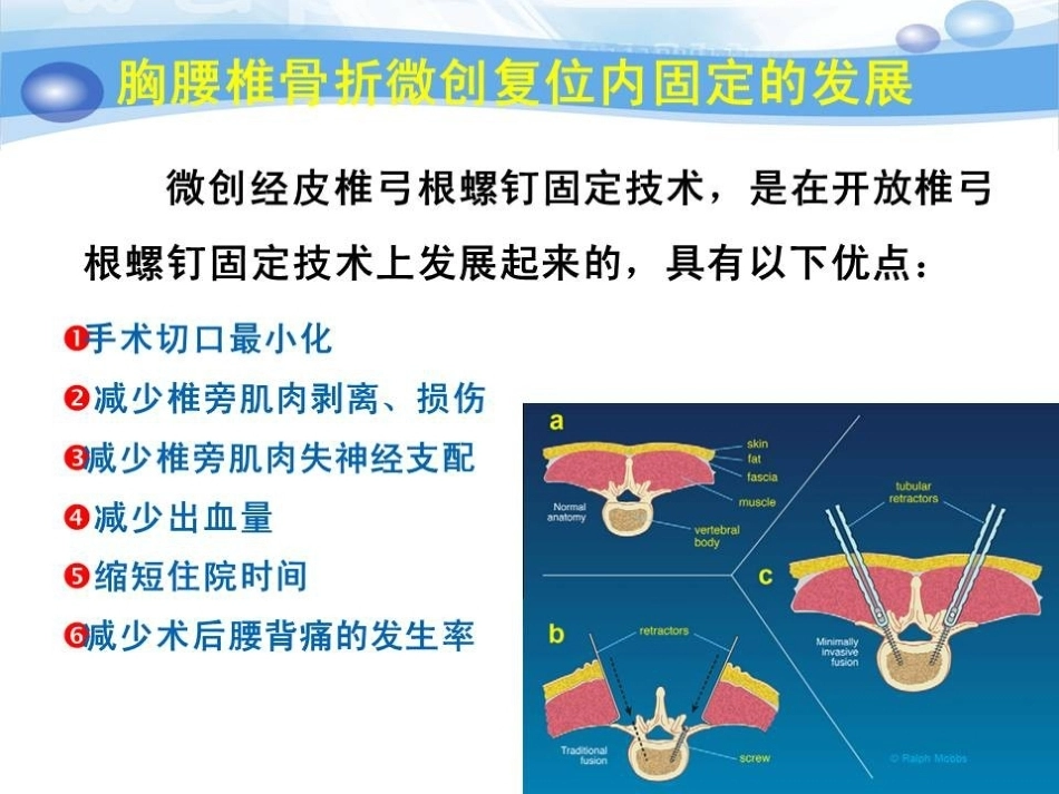急性胸腰椎骨折的手 术 技巧_第12页