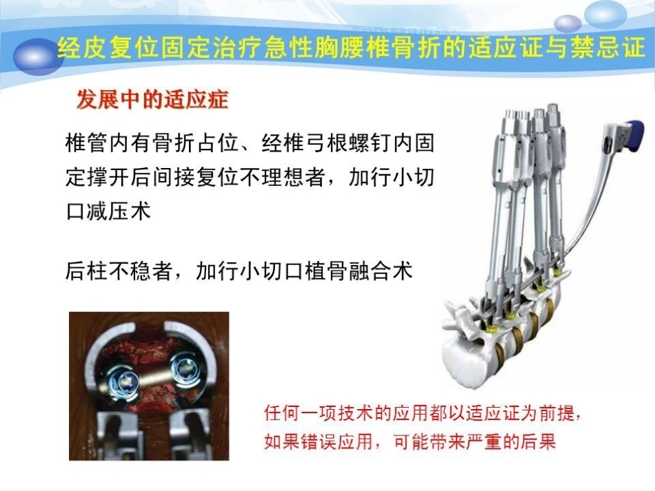 急性胸腰椎骨折的手 术 技巧_第14页