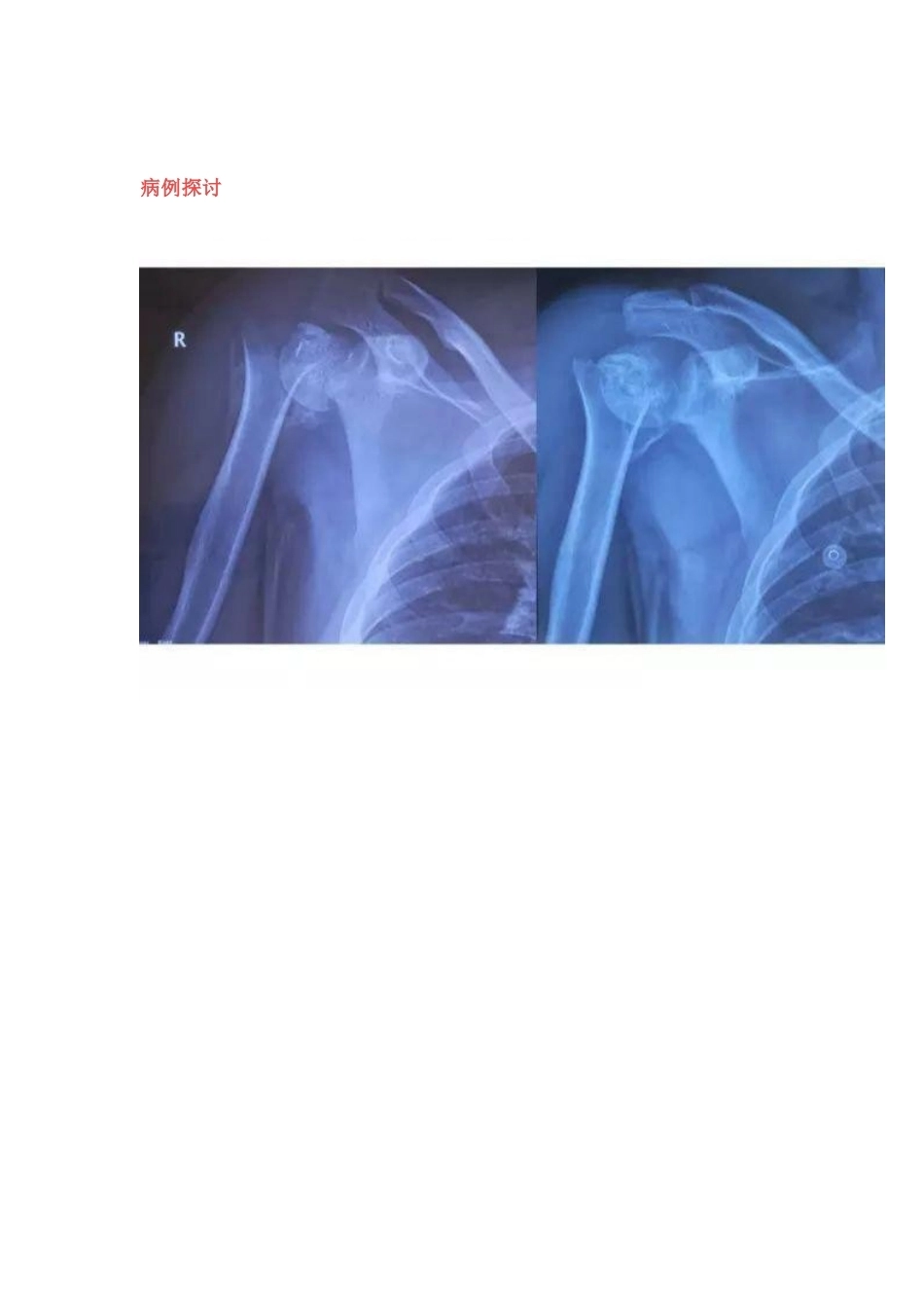 肩关节反向假体置换术 技巧_第1页