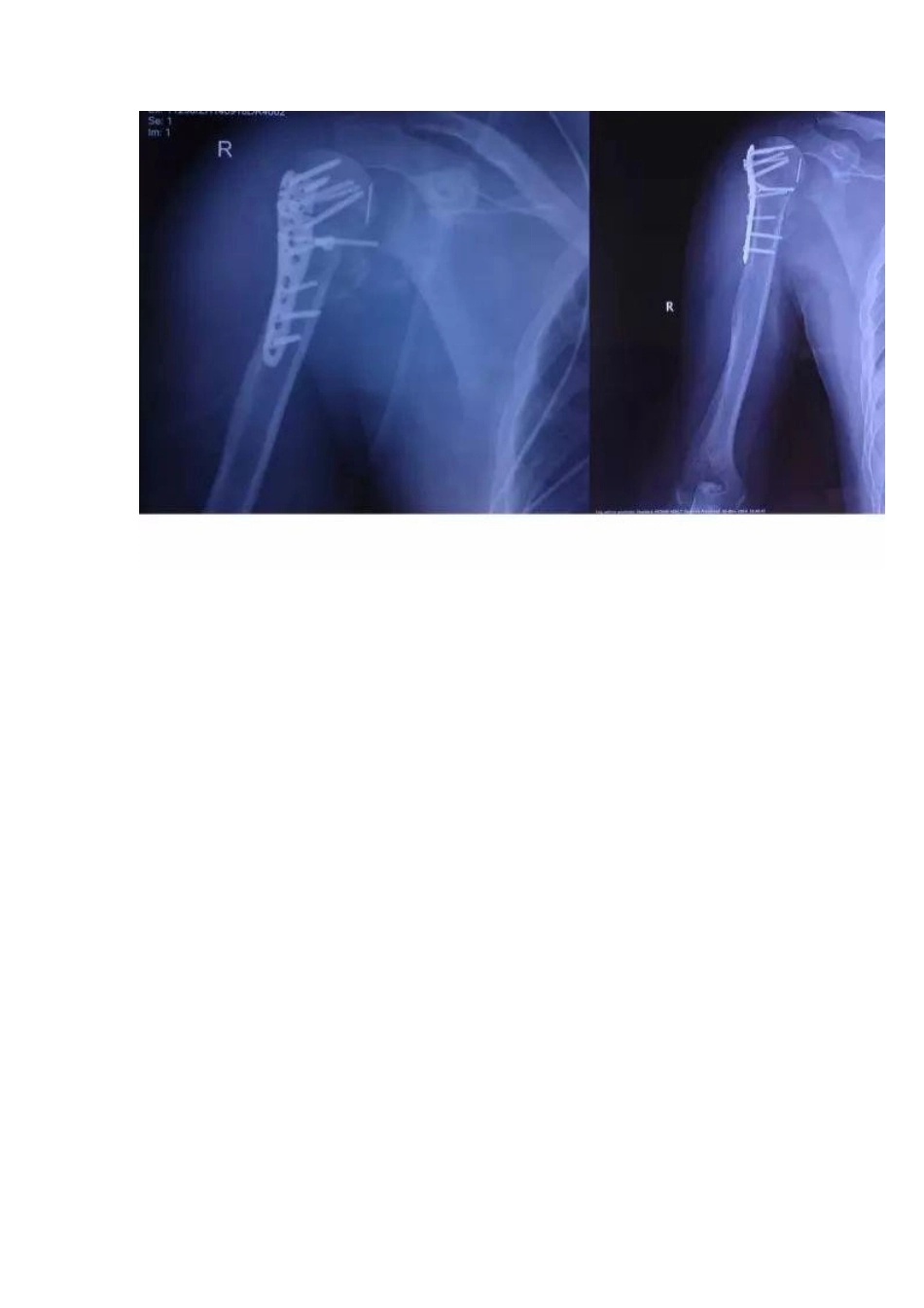 肩关节反向假体置换术 技巧_第2页