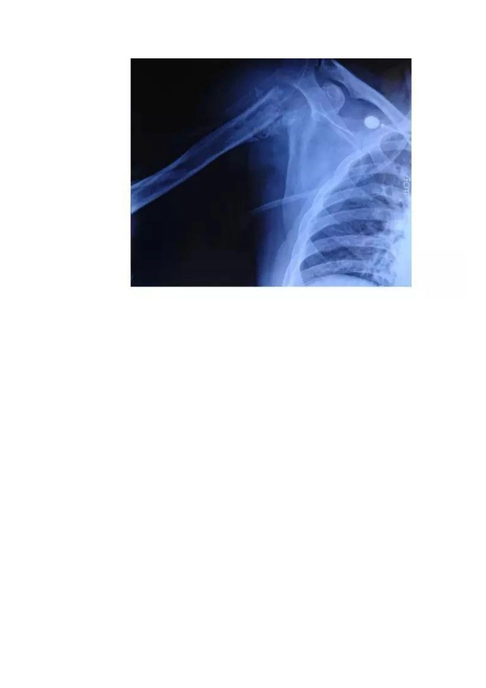 肩关节反向假体置换术 技巧_第5页