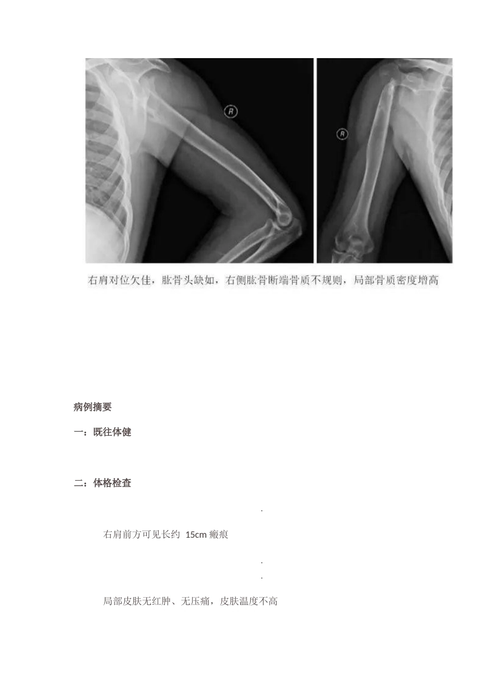 肩关节反向假体置换术 技巧_第6页