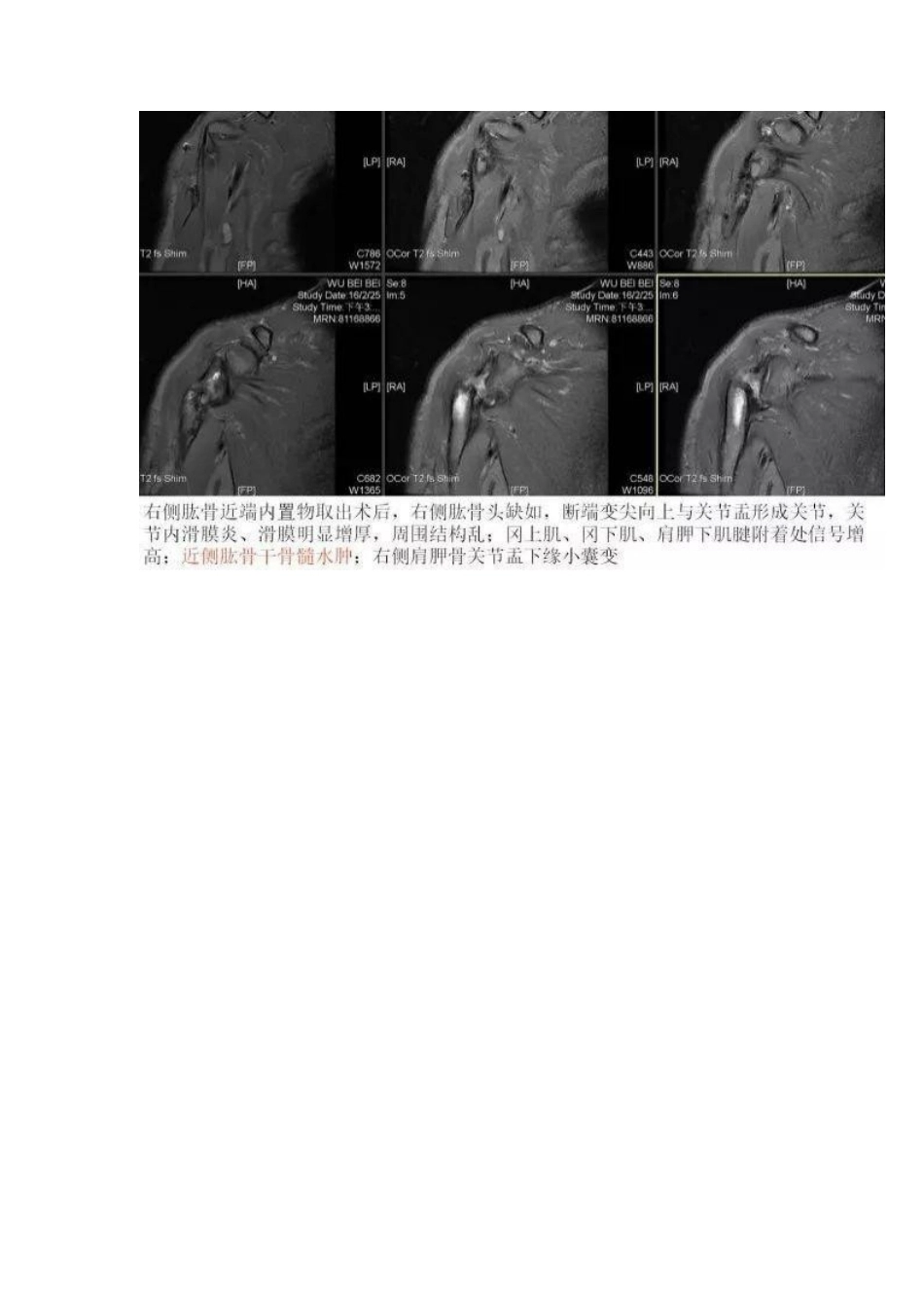 肩关节反向假体置换术 技巧_第8页