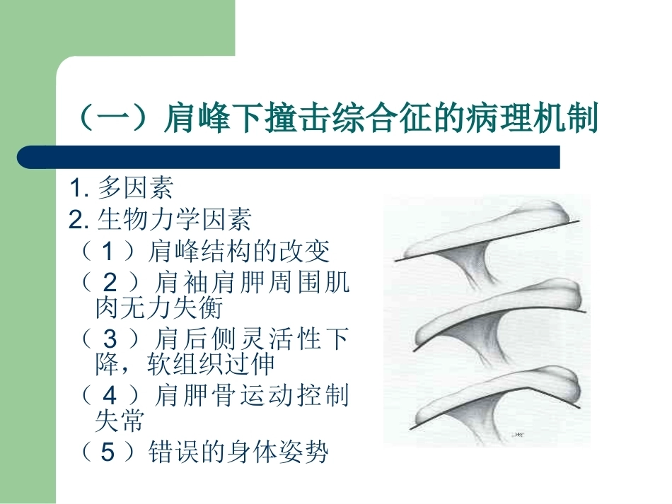 肩峰下撞击综合征_第13页