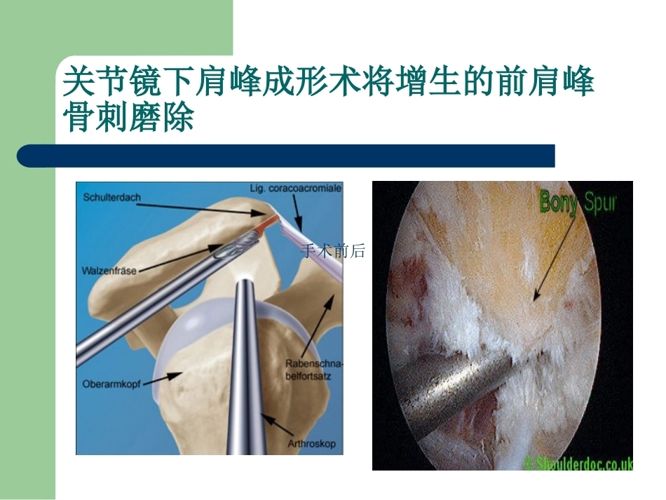 肩峰下撞击综合征_第15页