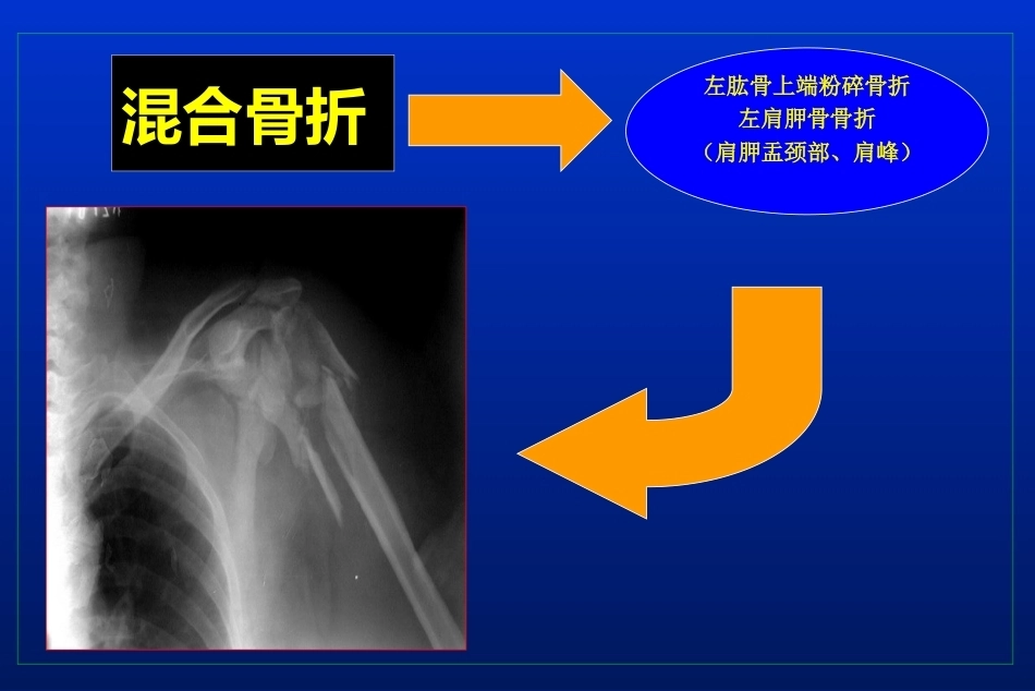 肩胛骨骨折_第12页