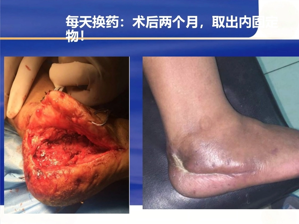 微创跟骨 骨折新_第11页