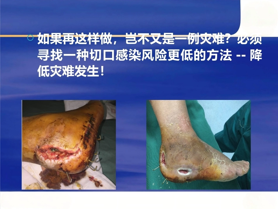 微创跟骨 骨折新_第12页