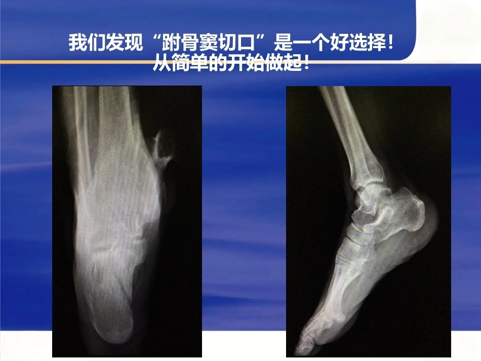 微创跟骨 骨折新_第15页