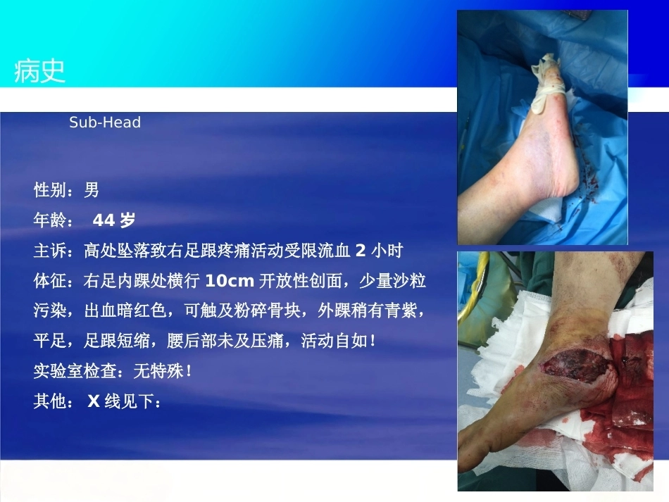 微创跟骨 骨折新_第2页