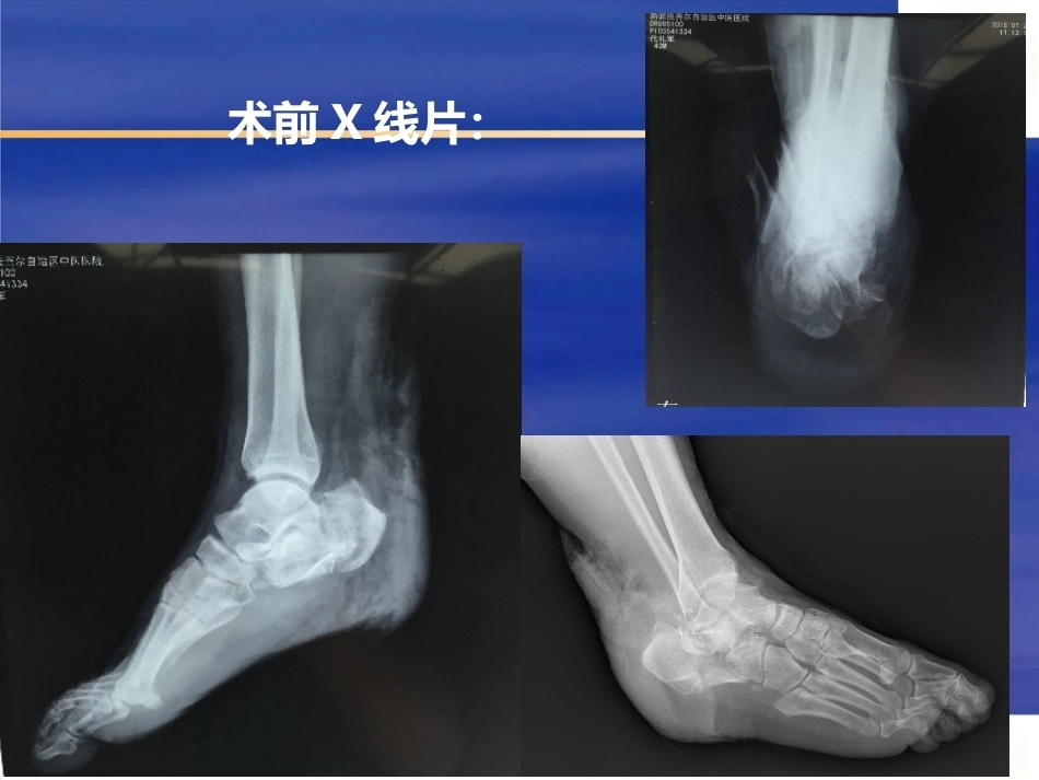 微创跟骨 骨折新_第4页