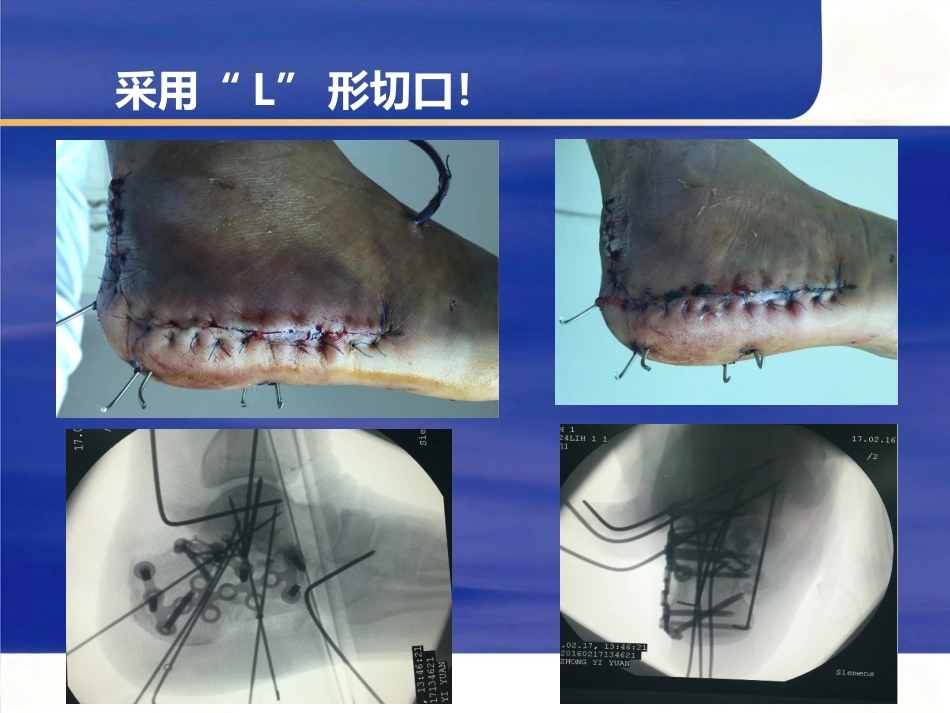 微创跟骨 骨折新_第8页